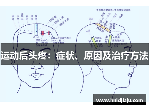 运动后头疼：症状、原因及治疗方法